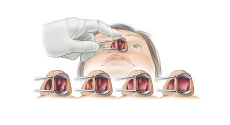 ¿Es recomendable operarse de rinitis crónica?