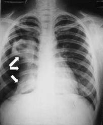 Conoce la tuberculosis pulmonar