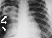 Conoce tuberculosis pulmonar