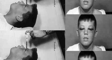 Lobotomía, el cruel y antiguo tratamiento psiquiátrico que horrorizó al mundo