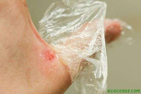 como curar una quemadura leve