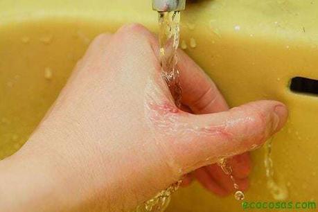 como curar una quemadura