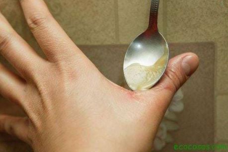 remedios para quemaduras