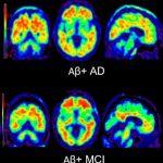 Asociaciones de actividad física y β-amiloide con cognición longitudinal y neurodegeneración en adultos mayores clínicamente normales.