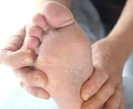 Remedios caseros para el pie de atleta. Síntomas y tratamiento remedios caseros para el pie de atleta