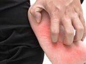 Remedios caseros para atleta. Síntomas tratamiento