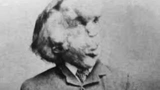 Reseña: El hombre elefante de Federick Treves