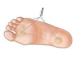 Cura alternativa para los callos