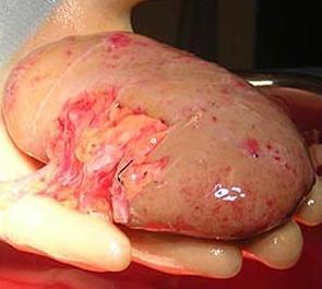 Riesgo de padecer anemia por Insuficiencia Renal Crónica (IRC)