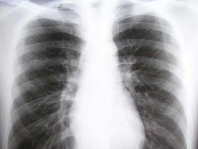 25% de los fumadores tiene  enfermedad pulmonar
