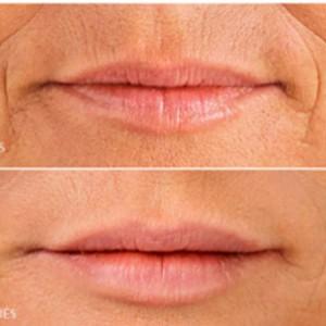 Rellenos faciales para devolver la juventud a tu rostro