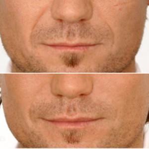 Rellenos faciales para devolver la juventud a tu rostro