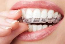 Tratamiento de Ortodoncia Invisible Tratamiento de Ortodoncia Invisible