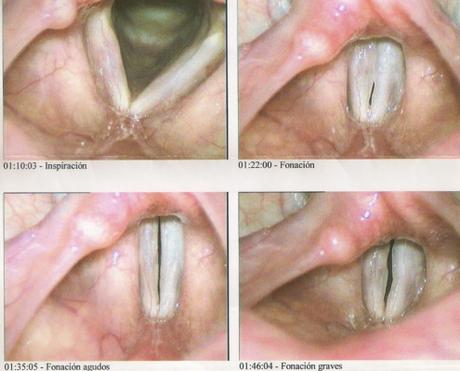 Cura tus cuerdas vocales inflamadas con el canto Cura tus cuerdas vocales inflamadas con el canto