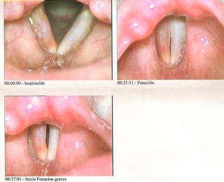 cuerdas-vocales-inflamadas