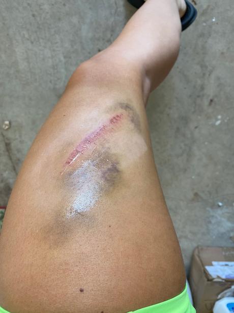 fotos de la lesión de Mandy Rose