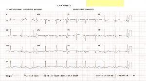 Migrañas: a propósito de un caso. ECG normal