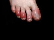 ¿sabes “dedos covid”? tienes quiere decir estas curando infeccion