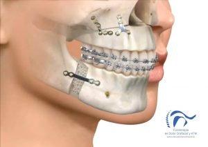 La fisioterapia en Cirugía Maxilofacial La fisioterapia en Cirugía Maxilofacial