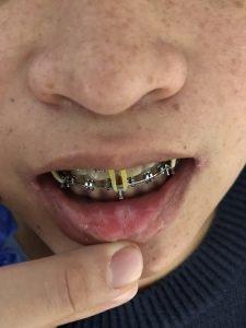 La fisioterapia en Cirugía Maxilofacial La fisioterapia en Cirugía Maxilofacial