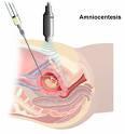 Amniocentesis: ¿una prueba riesgo?