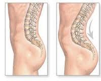 Cómo reducir las consecuencias de la Hiperlordosis lumbar