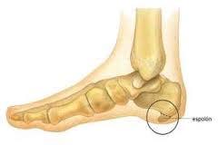 Las causas del espolón calcáneo