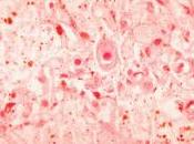 citomegalovirus, principal causante infecciones pacientes trasplantados