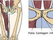 Pubalgia deportista