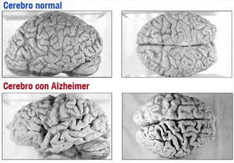 Posible nueva vía para tratar la enfermedad de Alzheimer