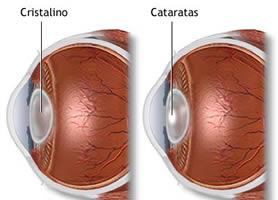 Anatomía: el cristalino