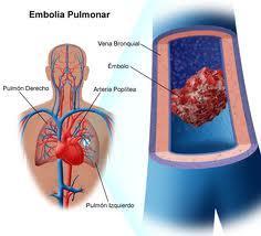 emboliapulmonar Tratamiento de la embolia pulmonar