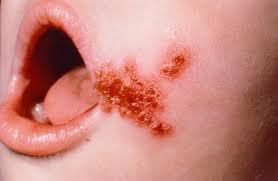 El impétigo: infección contagiosa de la piel