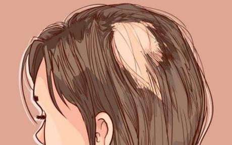 Cómo tratar la alopecia areata – Solución y tratamiento alopecia areta tratamientos