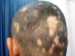 Alopecia areata tratamiento