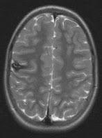 Vinculan los Angiomas Cavernosos con el Microbioma Intestinal