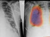 Hospital Italiano implementó herramienta diagnóstico imágenes basada Inteligencia Artificial asiste evaluación Covid-19.