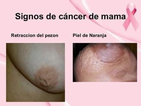signos de cancer de mama