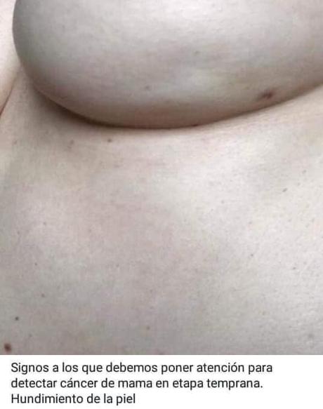 signos para detectar cancer de mama