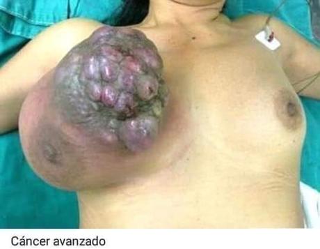 Cancer de mama