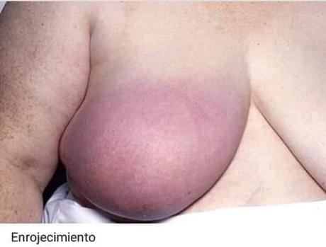 signos del cáncer de mama