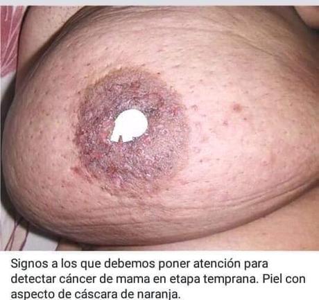 Cancer de mama