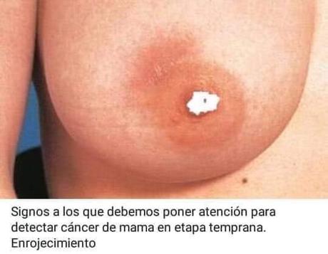 Cancer de mama