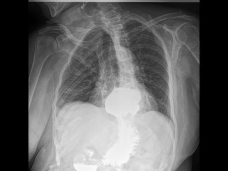 HERNIA HIATAL DESLIZANTE  Y PARAESOFAGICA