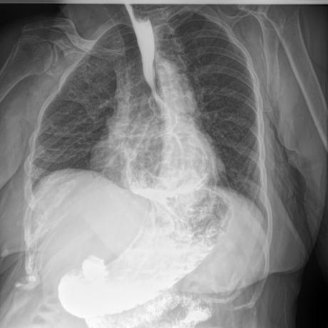 HERNIA HIATAL DESLIZANTE  Y PARAESOFAGICA