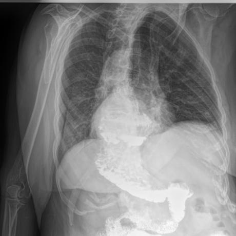 HERNIA HIATAL DESLIZANTE  Y PARAESOFAGICA