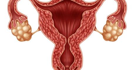 Inositol y Dieta en Ovarios Poliquísticos