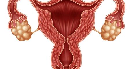 Inositol y Dieta en Ovarios Poliquísticos Inositol y Dieta en Ovarios Poliquísticos