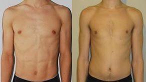 ECTOMORFO – El somatotipo del tipo delgado – DIETAS Y RUTINAS A la izquierda ectomorfo del tipo 1 / a la derecha ectomorfo del tipo 2