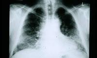 Nuevas pistas sobre la Fibrosis Pulmonar pueden ayudar a tratarla